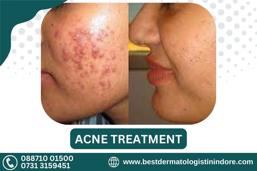 Best Acne Specialist in Indore